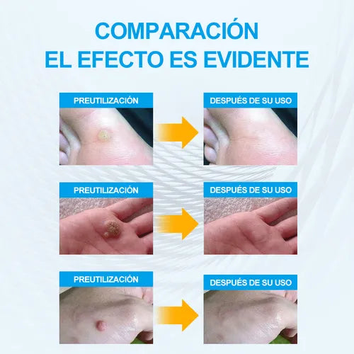FormuClear Parches – Remueve Verrugas Fácil – Recupera tu confianza sin dolor en casa